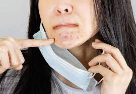 MASK ACNE AND RASHES ON THE RISE - HOW TO TREAT IT